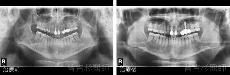 台中全口重建推薦