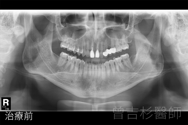 植牙取代假牙牙橋植牙實際案例分享@台中生活牙醫