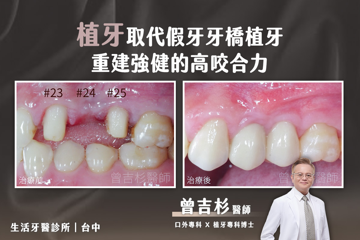 植牙取代假牙牙橋植牙實際案例分享@台中生活牙醫