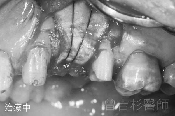 植牙取代假牙牙橋植牙實際案例分享@台中生活牙醫