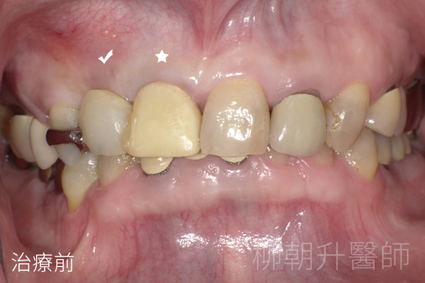 假牙牙橋牙根斷裂後重新製作假牙冠及植牙@南投生活牙醫
