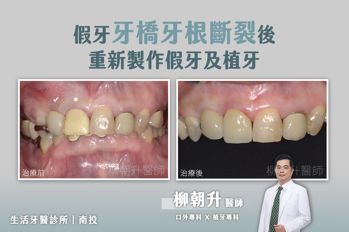 假牙牙橋牙根斷裂後重新製作假牙冠及植牙@南投生活牙醫