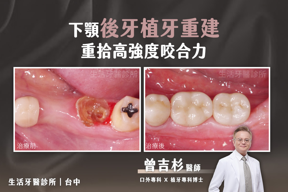 【台中植牙推薦】下顎後牙植牙重建咬合成功案例@台中生活牙醫