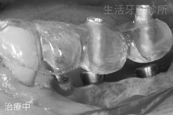 台中電腦導航植牙+台中數位植牙