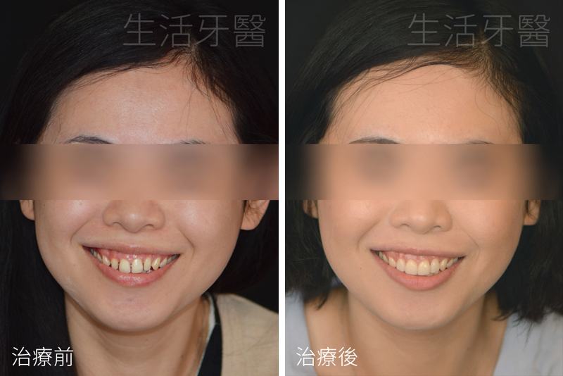 南屯假牙推薦+南屯牙醫診所