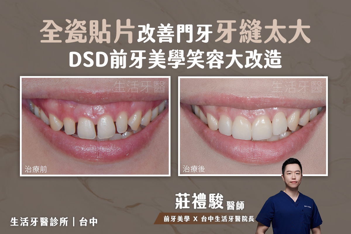 台中陶瓷貼片 - 四顆全瓷貼片 改善門牙牙縫太大 DSD微笑設計實際案例分享@台中生活牙醫