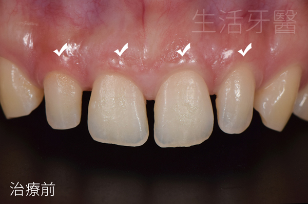 台中前牙美學權威+台中陶瓷貼片推薦