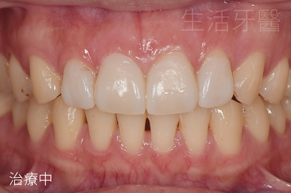 台中全瓷貼片推薦+台中全瓷貼片價錢價格費用