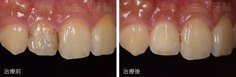 台中假牙價格+台中假牙費用價錢