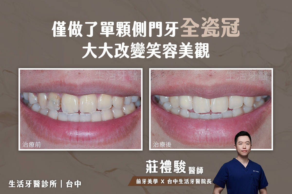台中 全瓷牙冠 推薦 - 側門牙 全瓷冠假牙 實際案例分享@台中生活牙醫