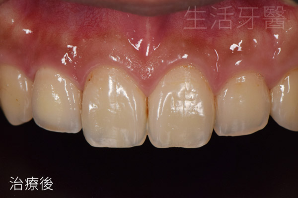 台中前牙美學+台中牙醫推薦ptt