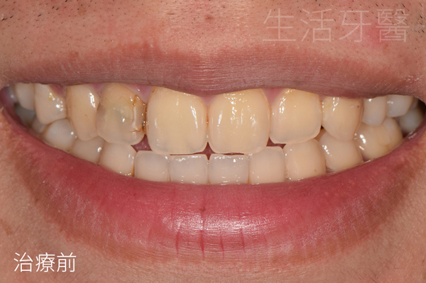 台中全瓷冠推薦ptt+台中全瓷牙冠推薦ptt