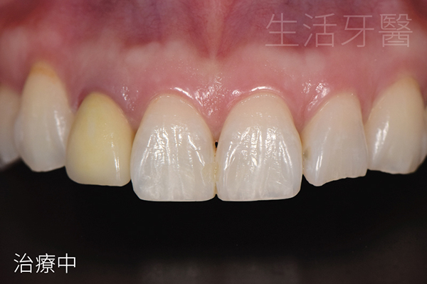 台中牙醫推薦 側門牙假牙重做全瓷冠合併牙齒居家美白療程 實際案例分享@台中生活牙醫