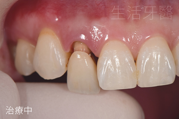 台中牙醫推薦 側門牙假牙重做全瓷冠合併牙齒居家美白療程 實際案例分享@台中生活牙醫