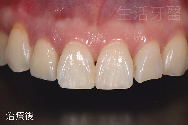 台中前牙美學+台中牙醫推薦ptt