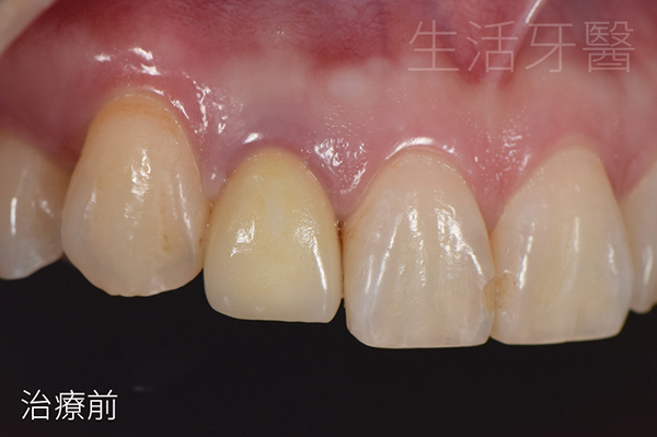 台中全瓷冠推薦ptt+台中全瓷牙冠推薦ptt