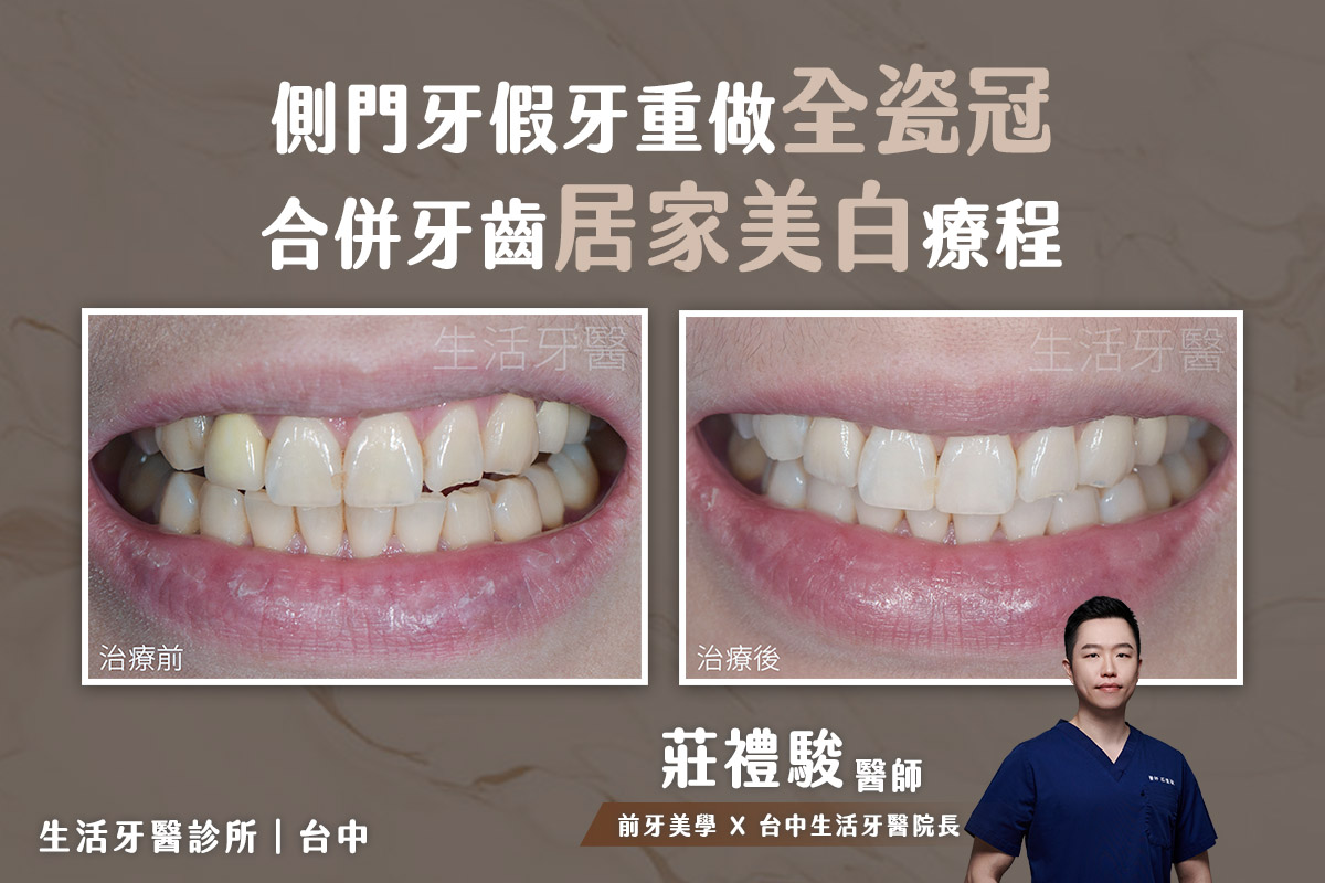 台中牙醫推薦 側門牙假牙重做全瓷冠合併牙齒居家美白療程 實際案例分享@台中生活牙醫