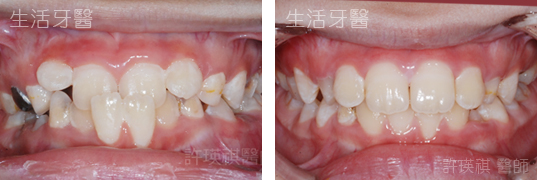 台中兒童牙齒矯正推薦 - 錯咬 局部牙齒矯正 門牙局部矯正 實際案例分享@台中生活牙醫
