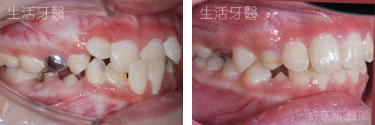 台中兒童牙齒矯正推薦 - 錯咬 局部牙齒矯正 門牙局部矯正 實際案例分享@台中生活牙醫