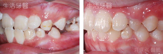 台中兒童牙齒矯正推薦 - 錯咬 局部牙齒矯正 門牙局部矯正 實際案例分享@台中生活牙醫