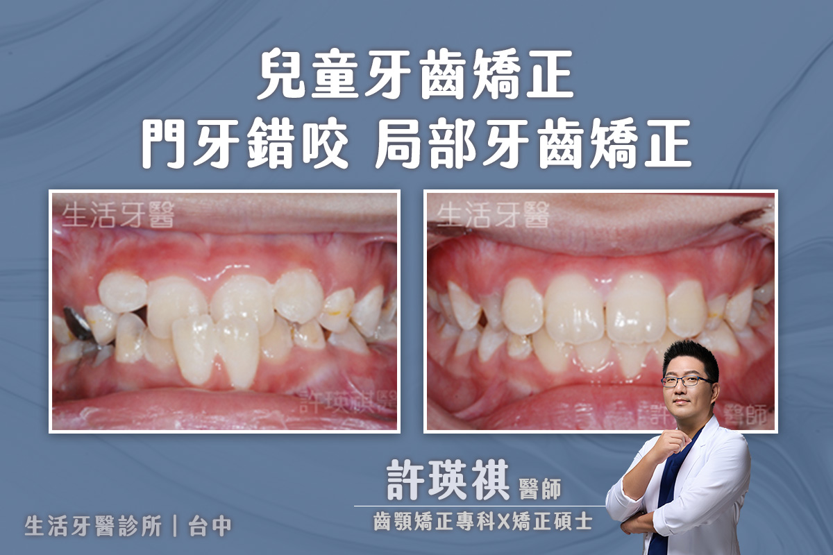 台中兒童牙齒矯正推薦 - 錯咬 局部牙齒矯正 門牙局部矯正 實際案例分享@台中生活牙醫