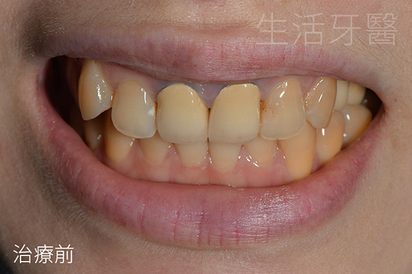 台中全瓷冠推薦+台中全瓷冠牙醫PTT
