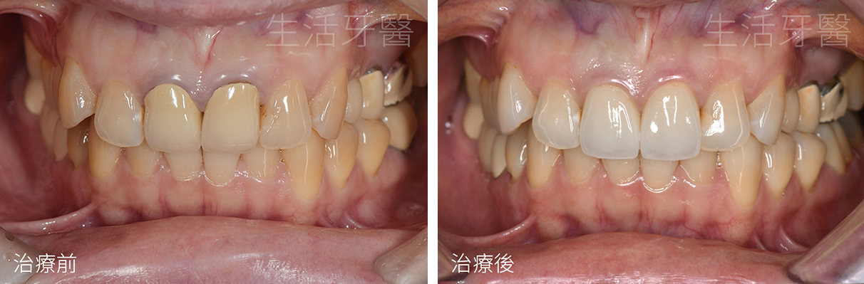 台中假牙冠推薦+台中牙醫診所推薦