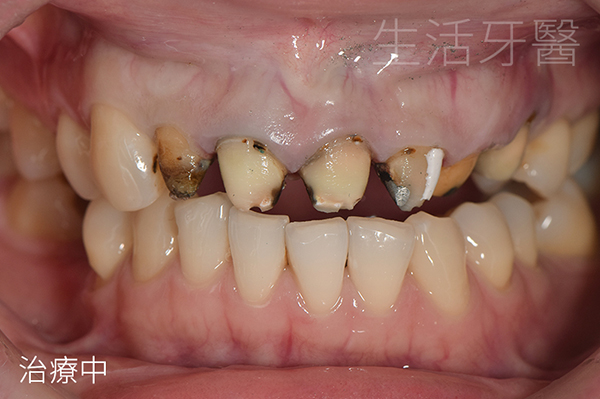 全瓷冠假牙重作打造完美笑容 告別牙齦變黑的金屬假牙 @台中生活牙醫