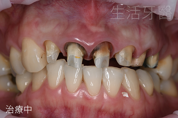 全瓷冠假牙重作打造完美笑容 告別牙齦變黑的金屬假牙 @台中生活牙醫