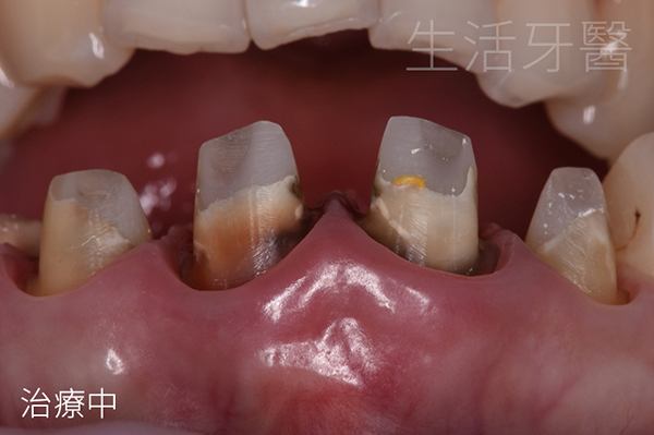台中全瓷冠推薦權威+台中生活牙醫評價心得