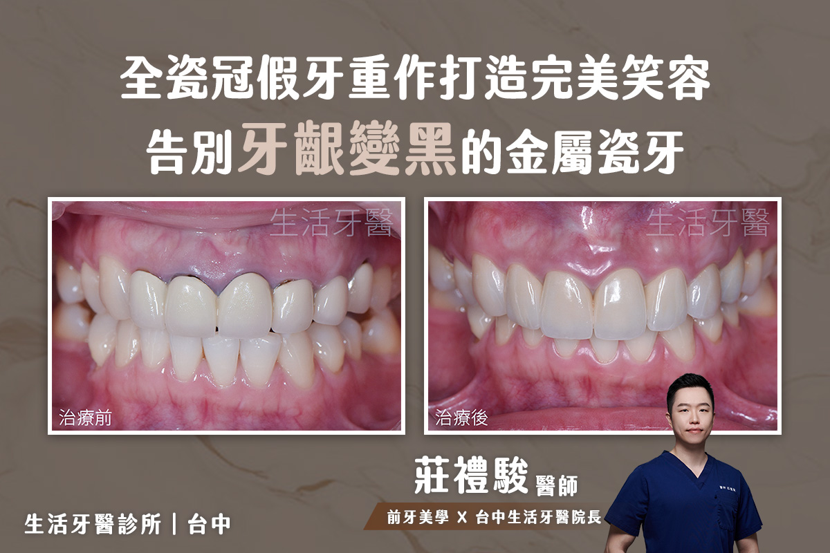 全瓷冠假牙重作打造完美笑容 告別牙齦變黑的金屬假牙 @台中生活牙醫