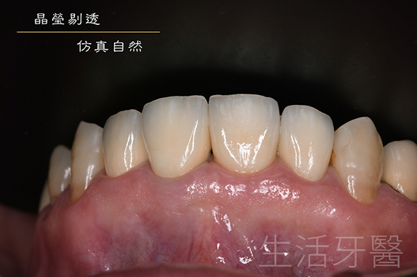 台中假牙冠推薦+台中牙醫診所推薦