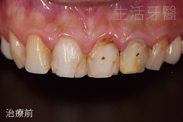 換掉舊假牙重新打造全瓷冠 再造美麗笑容