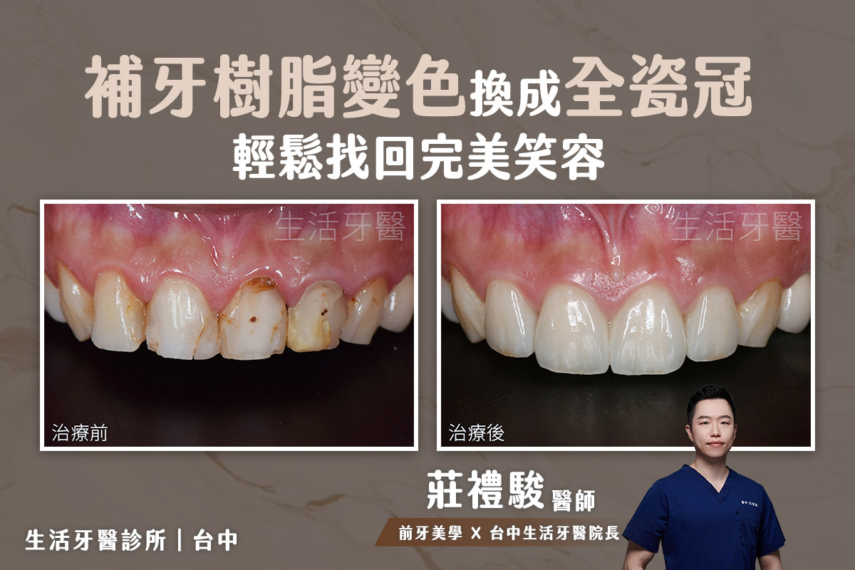 補牙樹脂變色換成全瓷冠假牙 輕鬆找回完美笑容