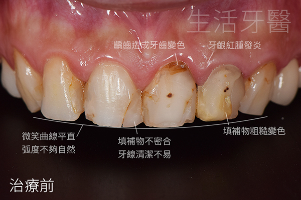 台中全瓷冠推薦權威+台中生活牙醫評價心得