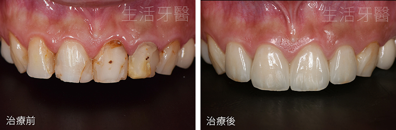 台中假牙冠推薦+台中牙醫診所推薦