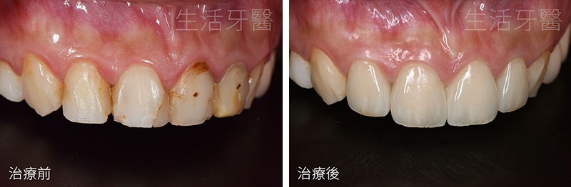 南屯假牙推薦+南屯牙醫診所