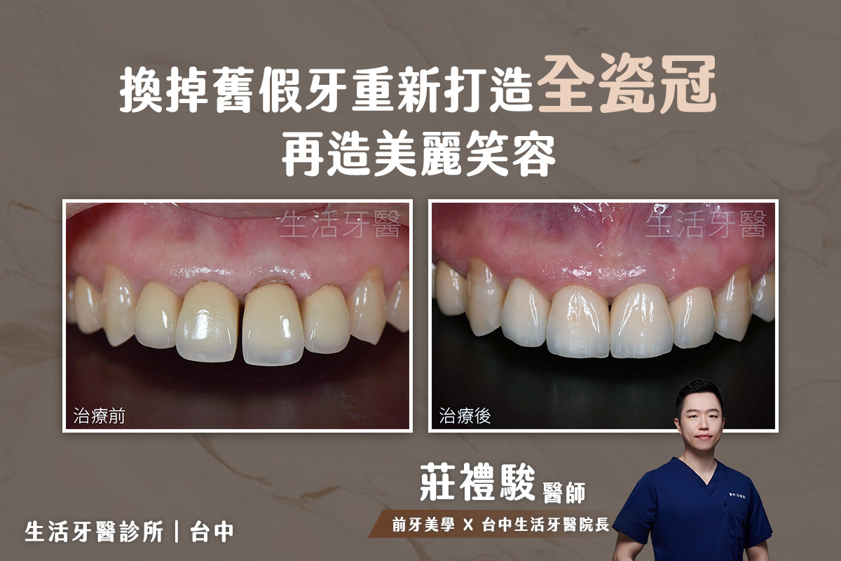 換掉舊假牙重新打造全瓷冠 再造美麗笑容