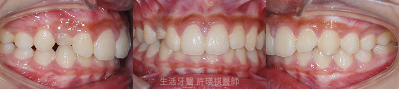 台中陶瓷貼片+台中瓷牙貼片