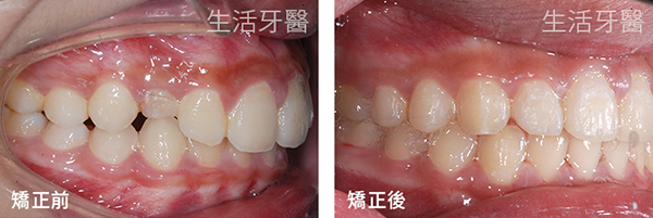 台中兒童矯正-牙齒長不出來 上顎犬齒阻生齒拉出 實際案例分享@台中生活牙醫