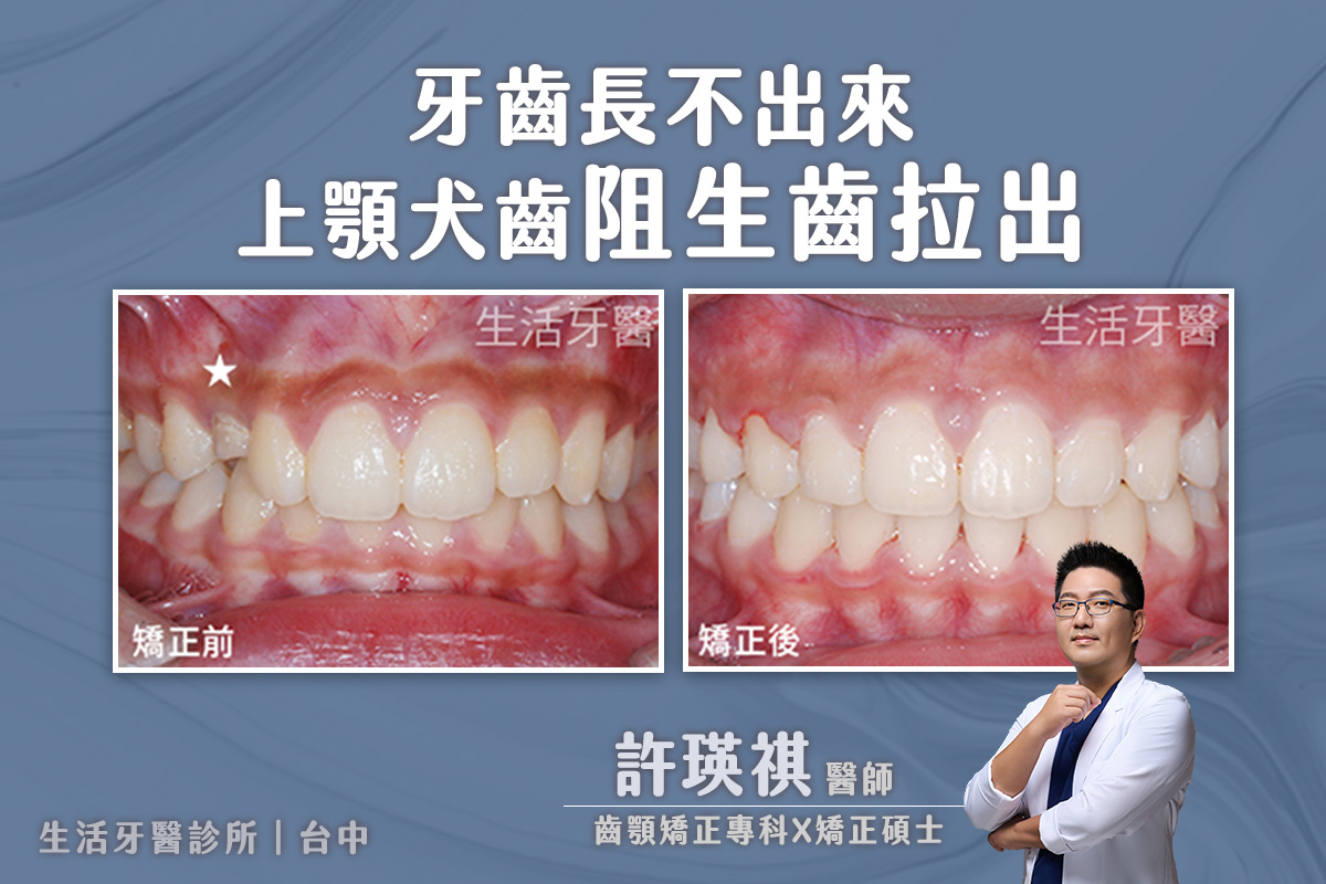 台中兒童矯正-牙齒長不出來 上顎犬齒阻生齒拉出 實際案例分享@台中生活牙醫