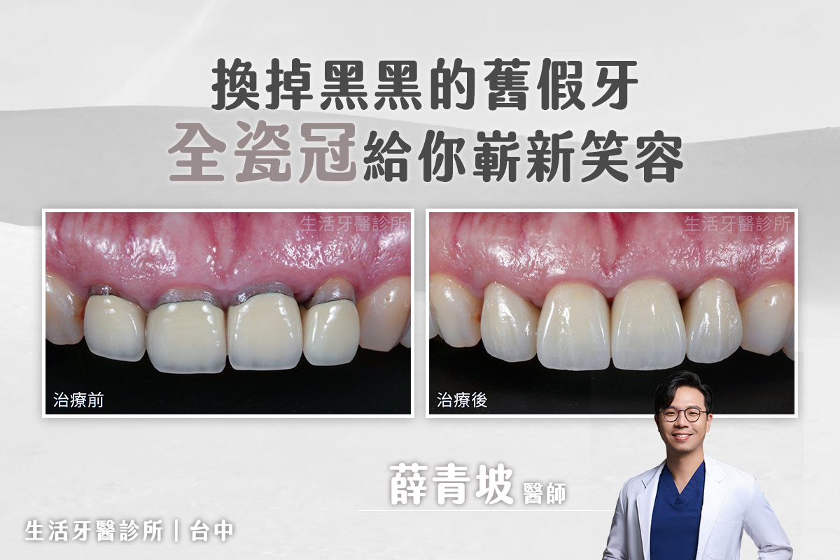 換掉黑黑的舊假牙，全瓷冠給你嶄新笑容