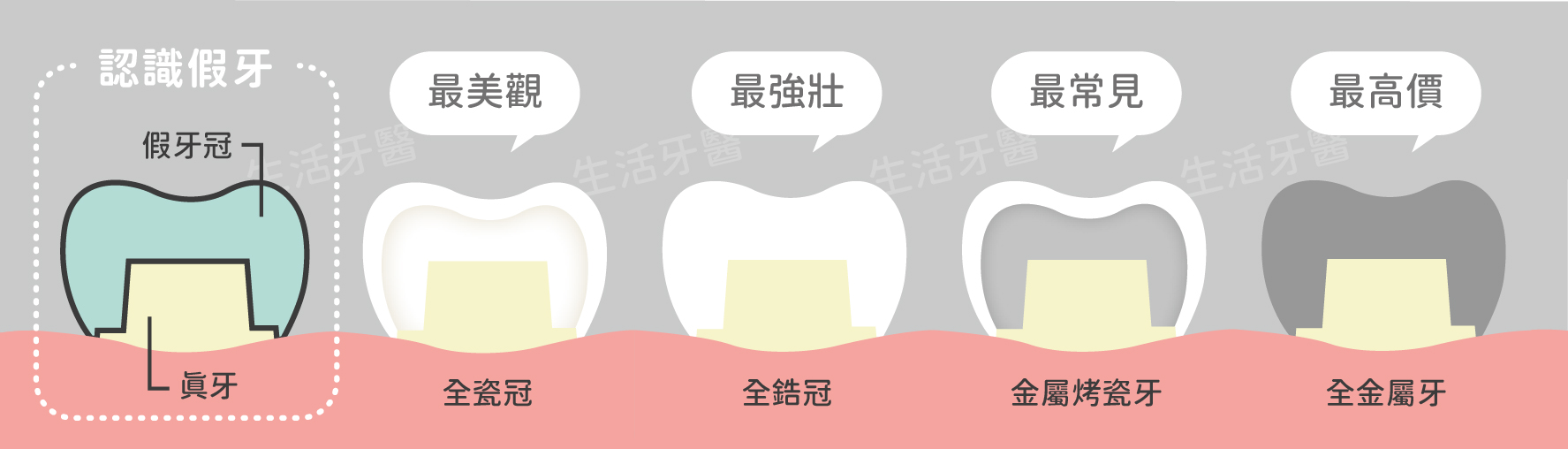 台中假牙套價錢費用價格收費