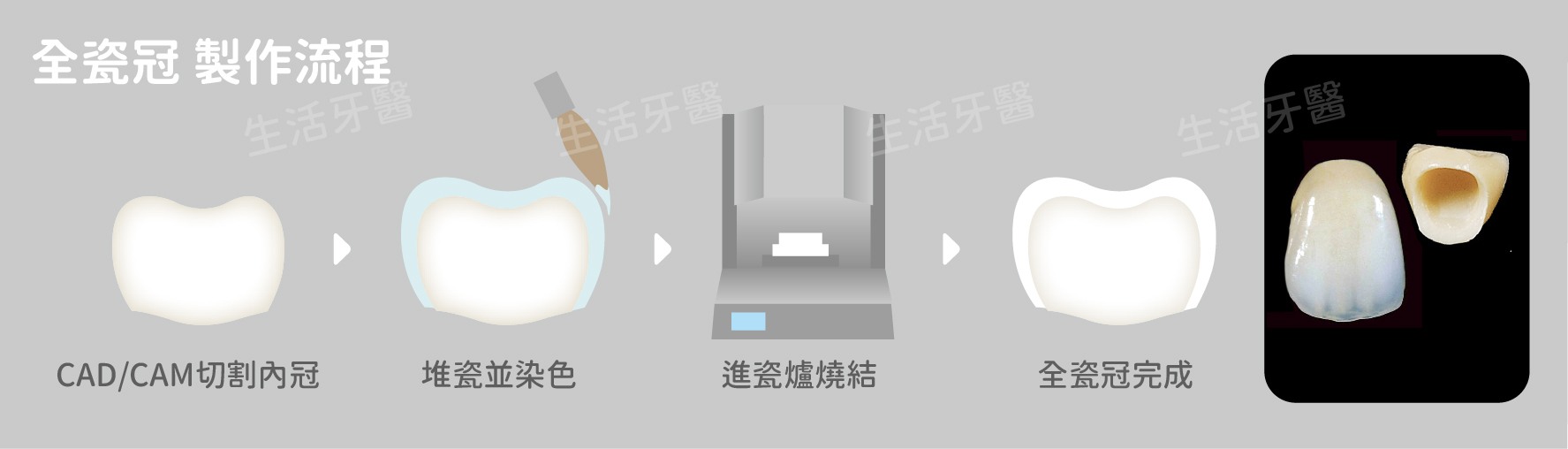 台中全瓷冠假牙推薦牙醫價錢費用