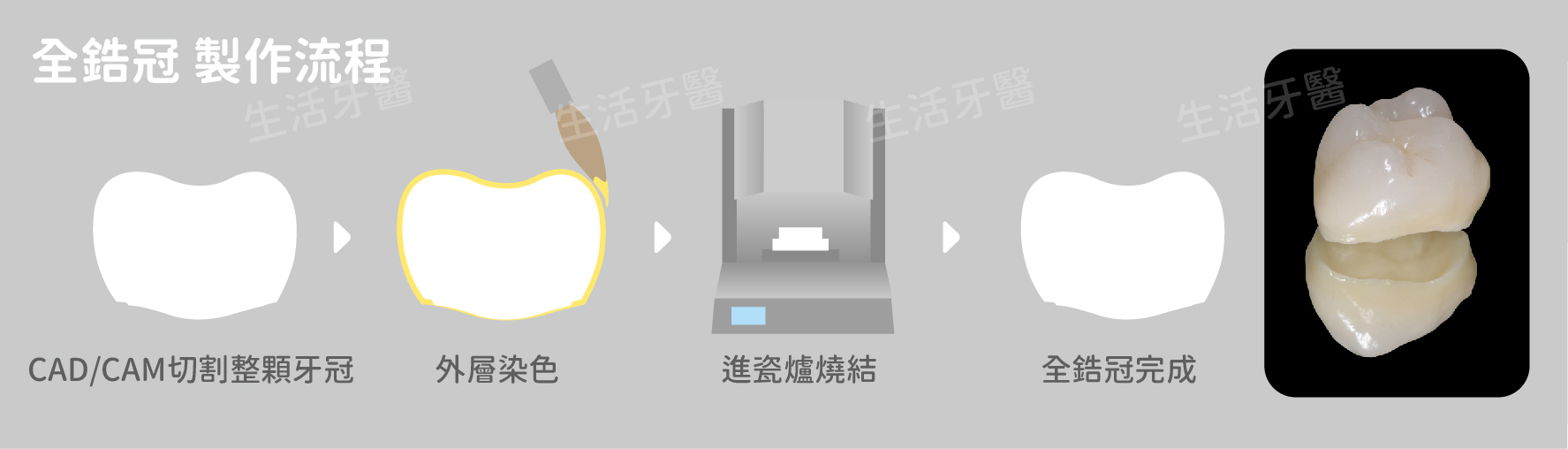 台中全鋯冠假牙推薦牙醫價格價錢收費