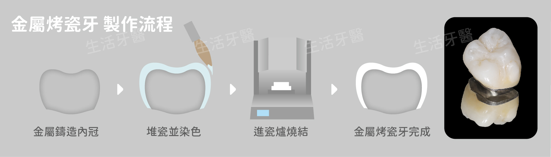 南投假牙冠推薦牙醫價錢費用價格收費