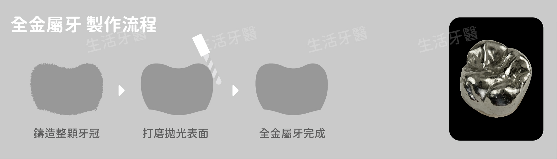 假牙冠材質比較推薦牙醫