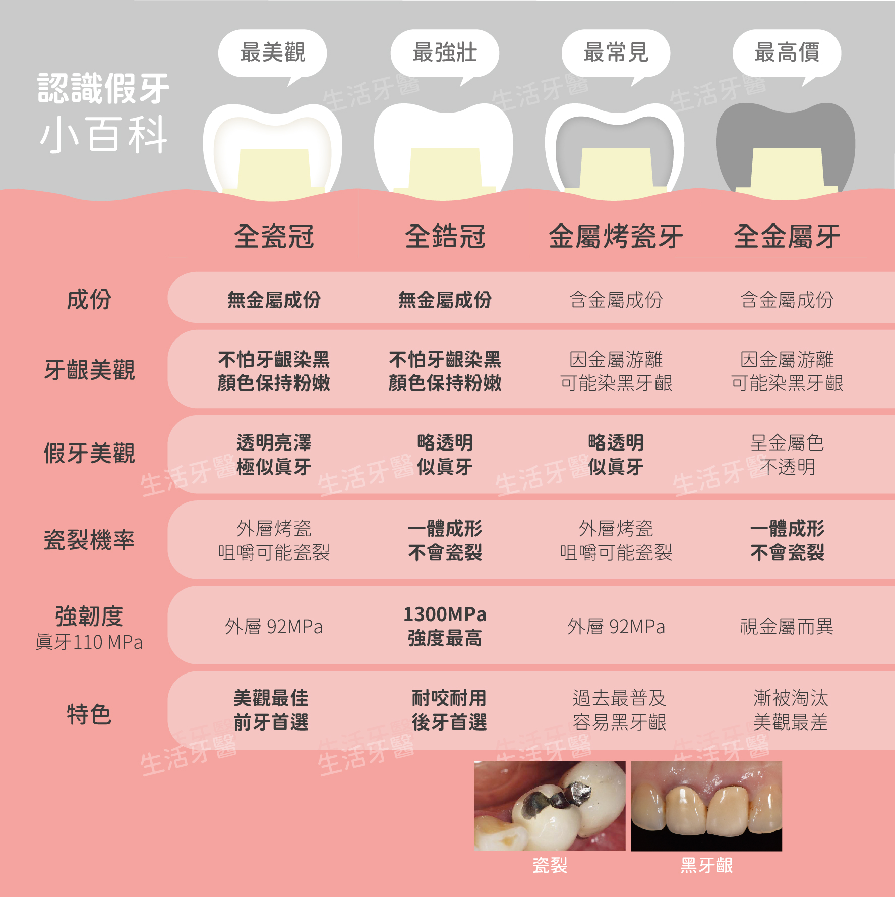 南投台中假牙套推薦牙醫價錢ptt