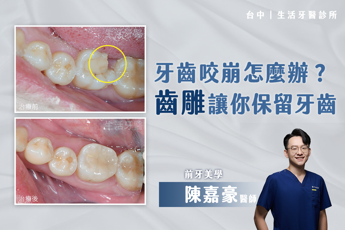 台中牙醫推薦｜牙齒咬崩咬裂怎麼辦？齒雕讓你保留牙齒，不用抽神經，免做假牙