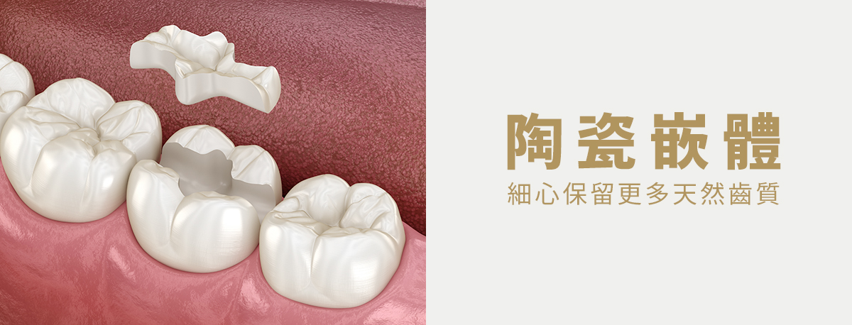 台中陶瓷貼片+台中瓷牙貼片